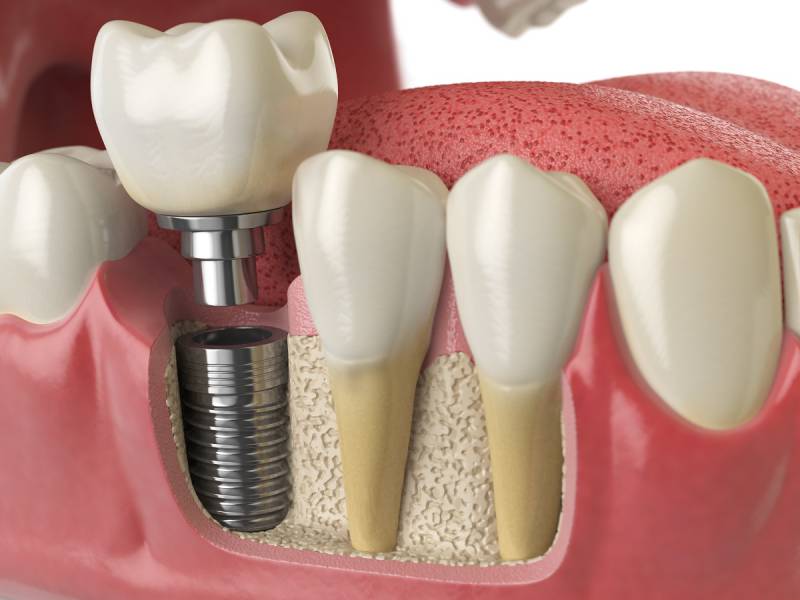 Implante Dental é Caro?