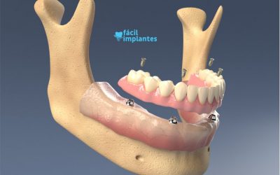 Qual o valor do implante dentário?