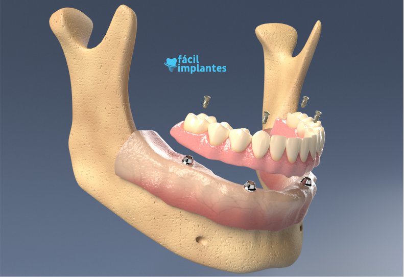 O Que São Implantes Dentários? Como São Feitos?