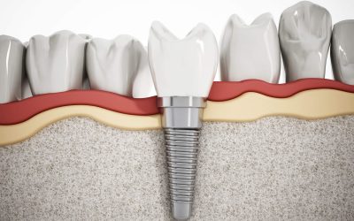 Implantes Dentários de Carga Imediata