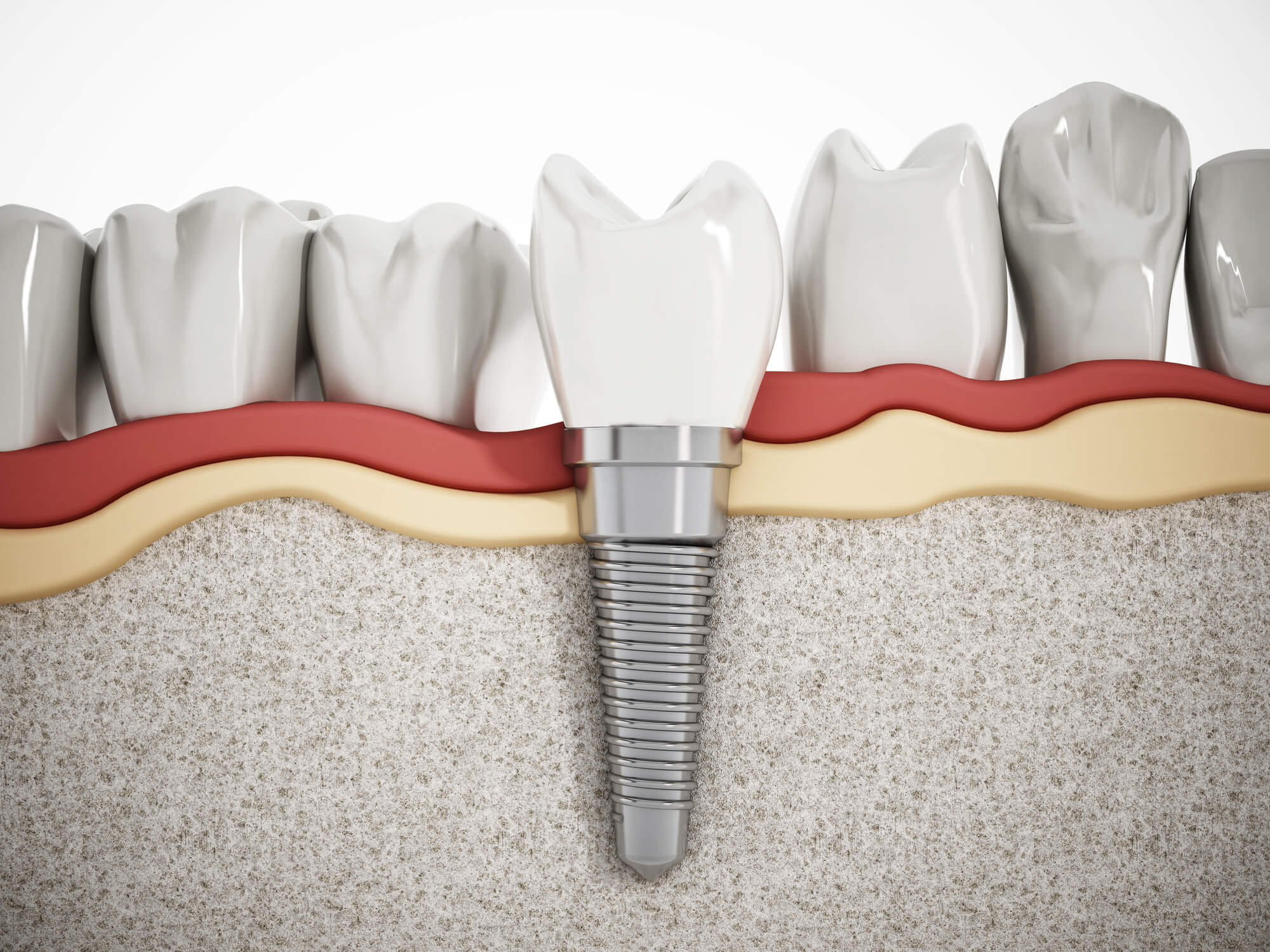 Implantes Dentários de Carga Imediata