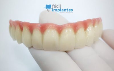 Quanto Custa Um Implante Dentário?