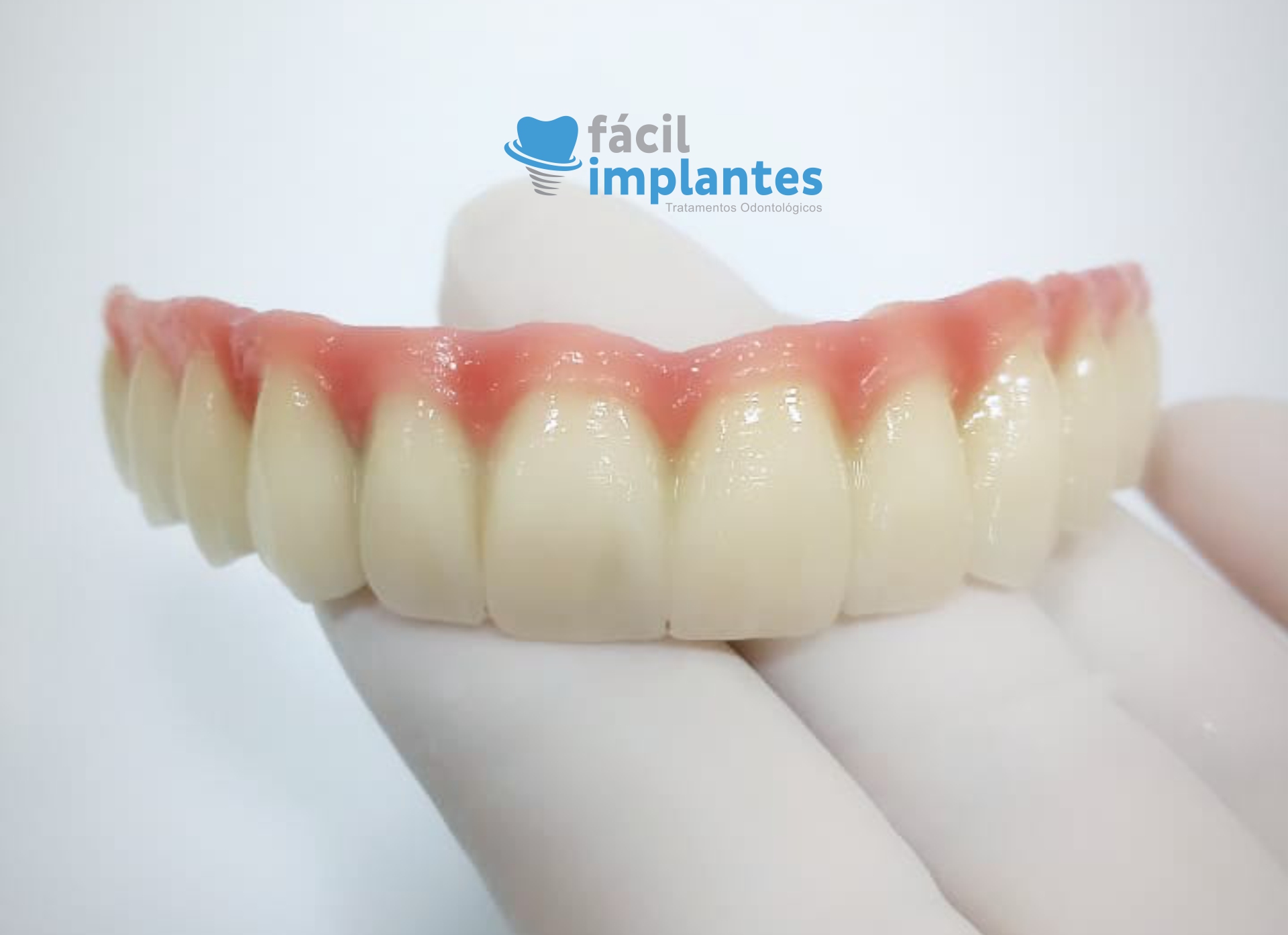 Quanto Custa Um Implante Dentário?