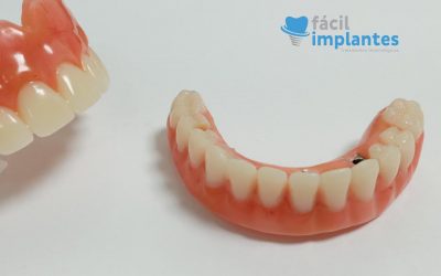 Overdenture: Prótese Sobre Implantes