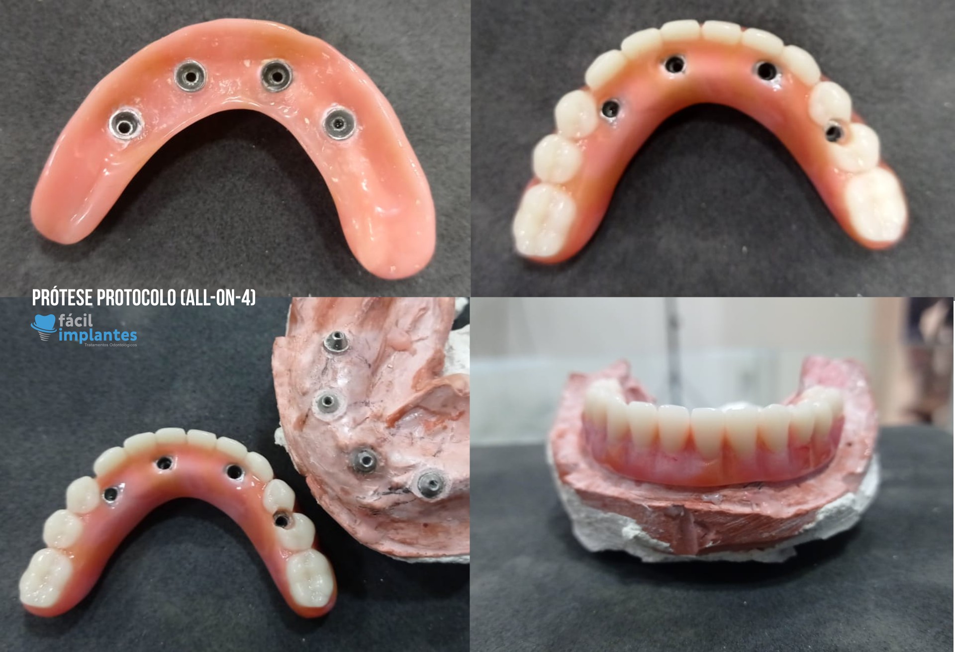 Prótese Protocolo – Carga Imediata – All On Four
