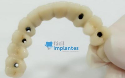 Quais São Os Tipos de Implantes Dentários Que Existem?