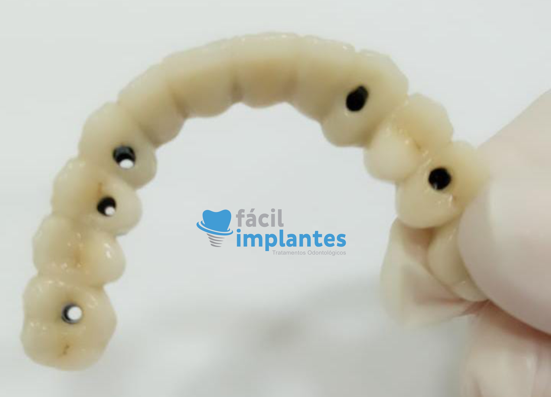 Quais São Os Tipos de Implantes Dentários Que Existem?