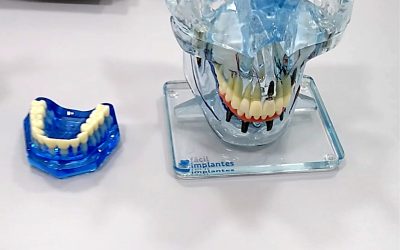 7 Mitos sobre Implantes Dentários