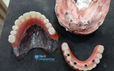 Você sabe o que é membrana L-PRF? E como isso é usado em implantes dentários?