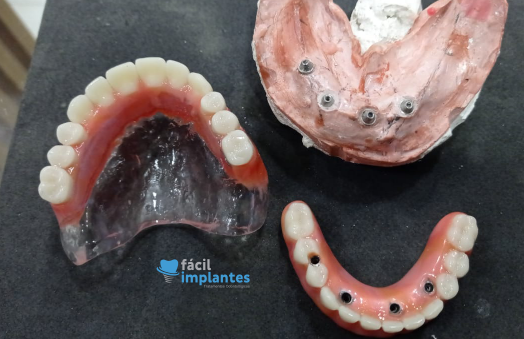 Você sabe o que é membrana L-PRF? E como isso é usado em implantes dentários?