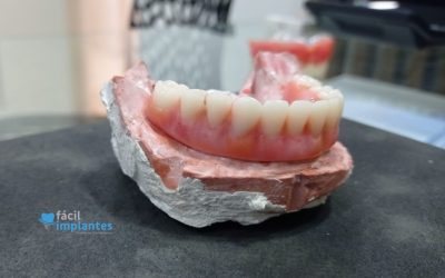 Mitos e verdades sobre implantes dentários