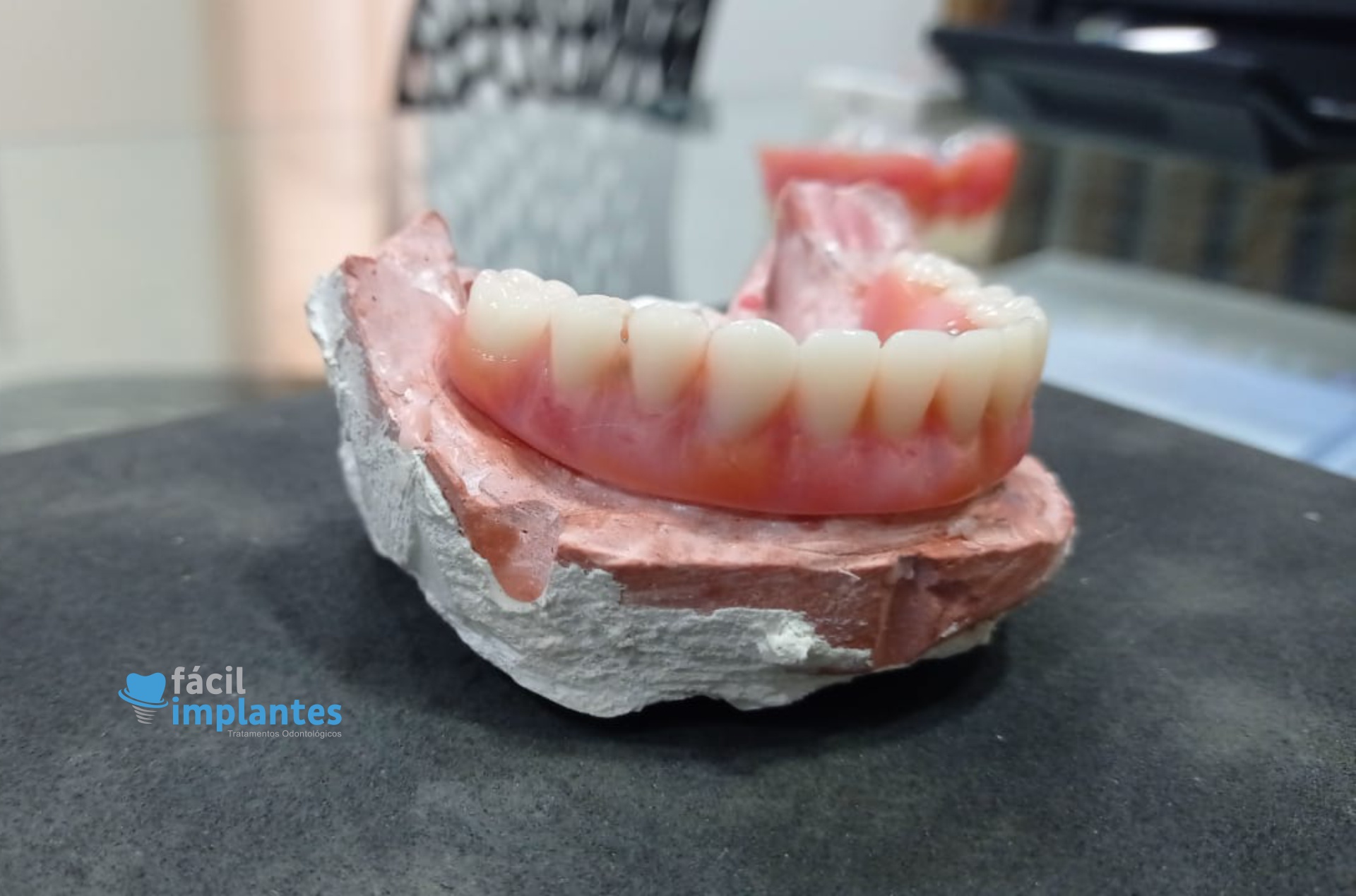 Mitos e verdades sobre implantes dentários