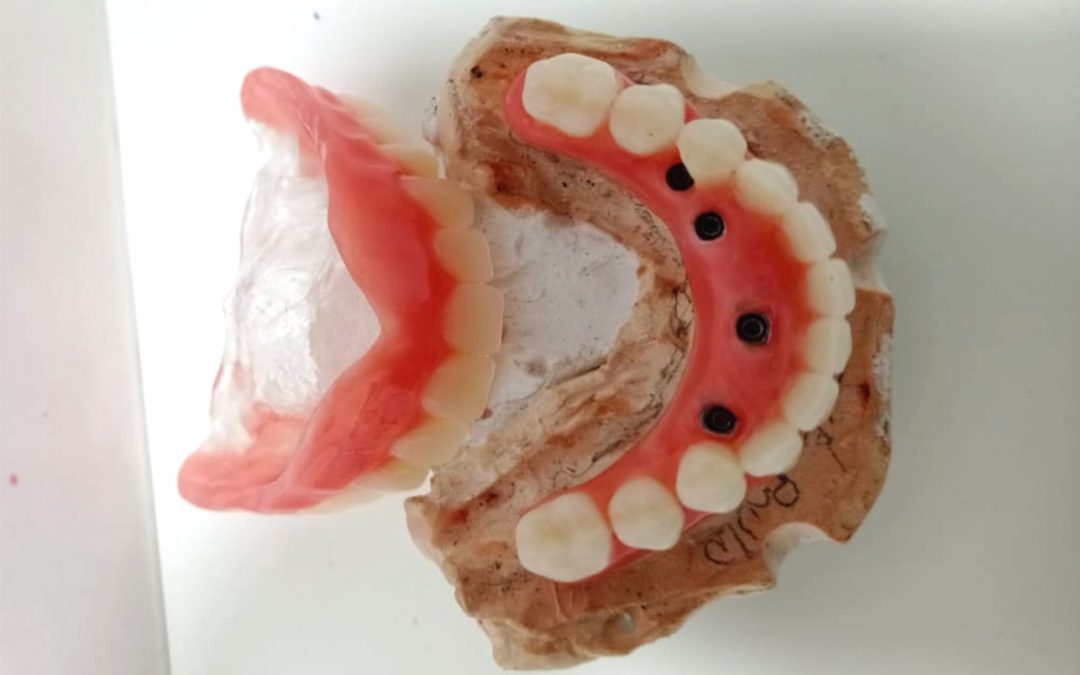 Principais benefícios dos implantes dentários