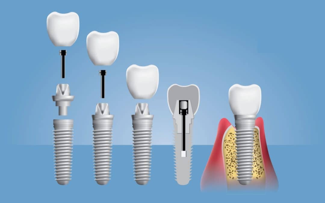 5 tipos de implantes dentários: indicações e como é o tratamento
