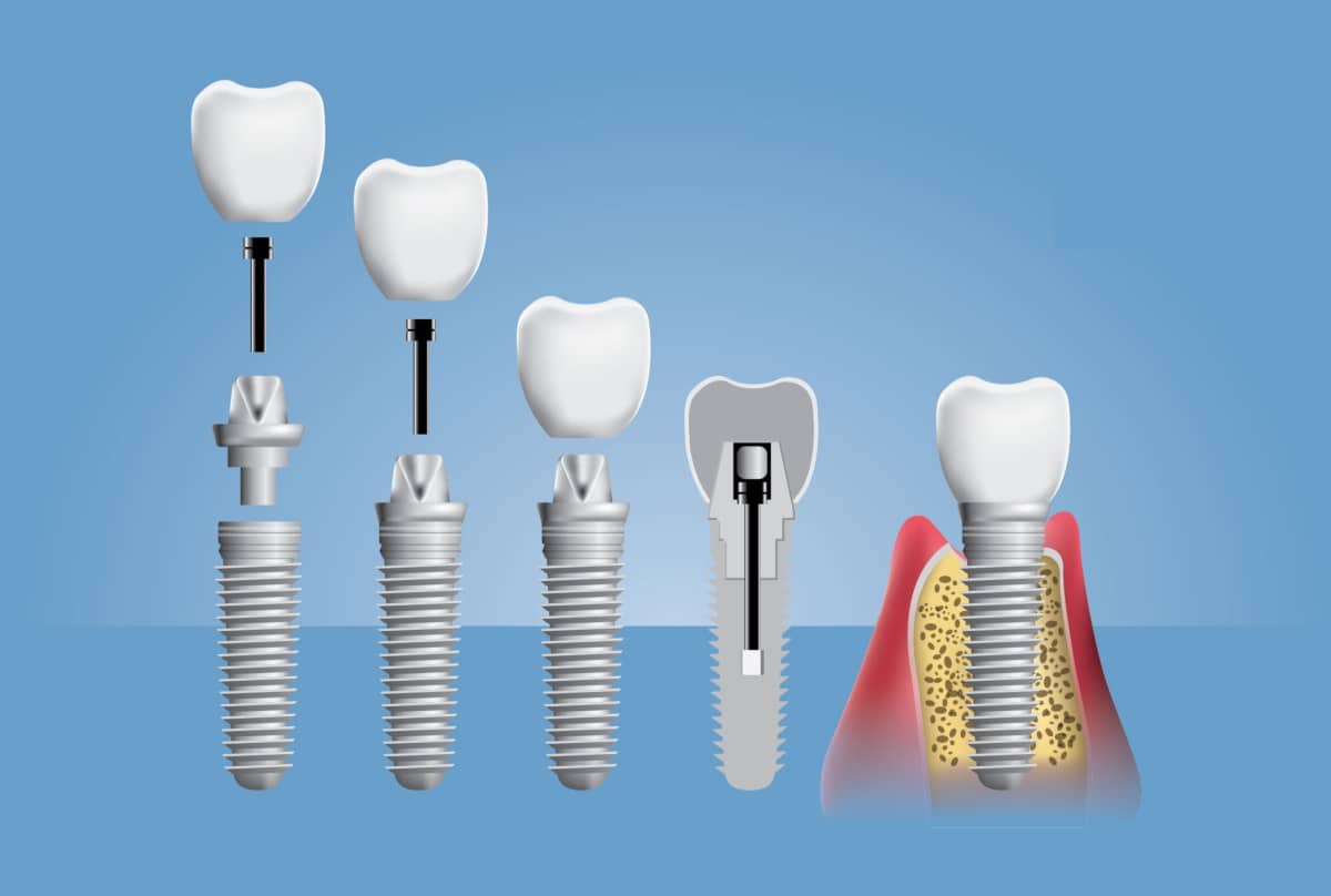 5 tipos de implantes dentários: indicações e como é o tratamento