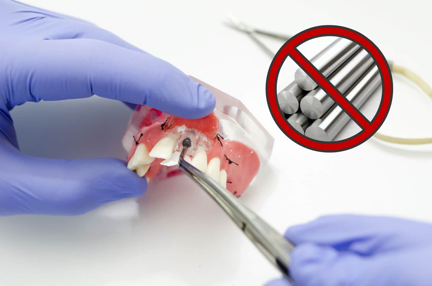 Implante Dental livre de Alumínio