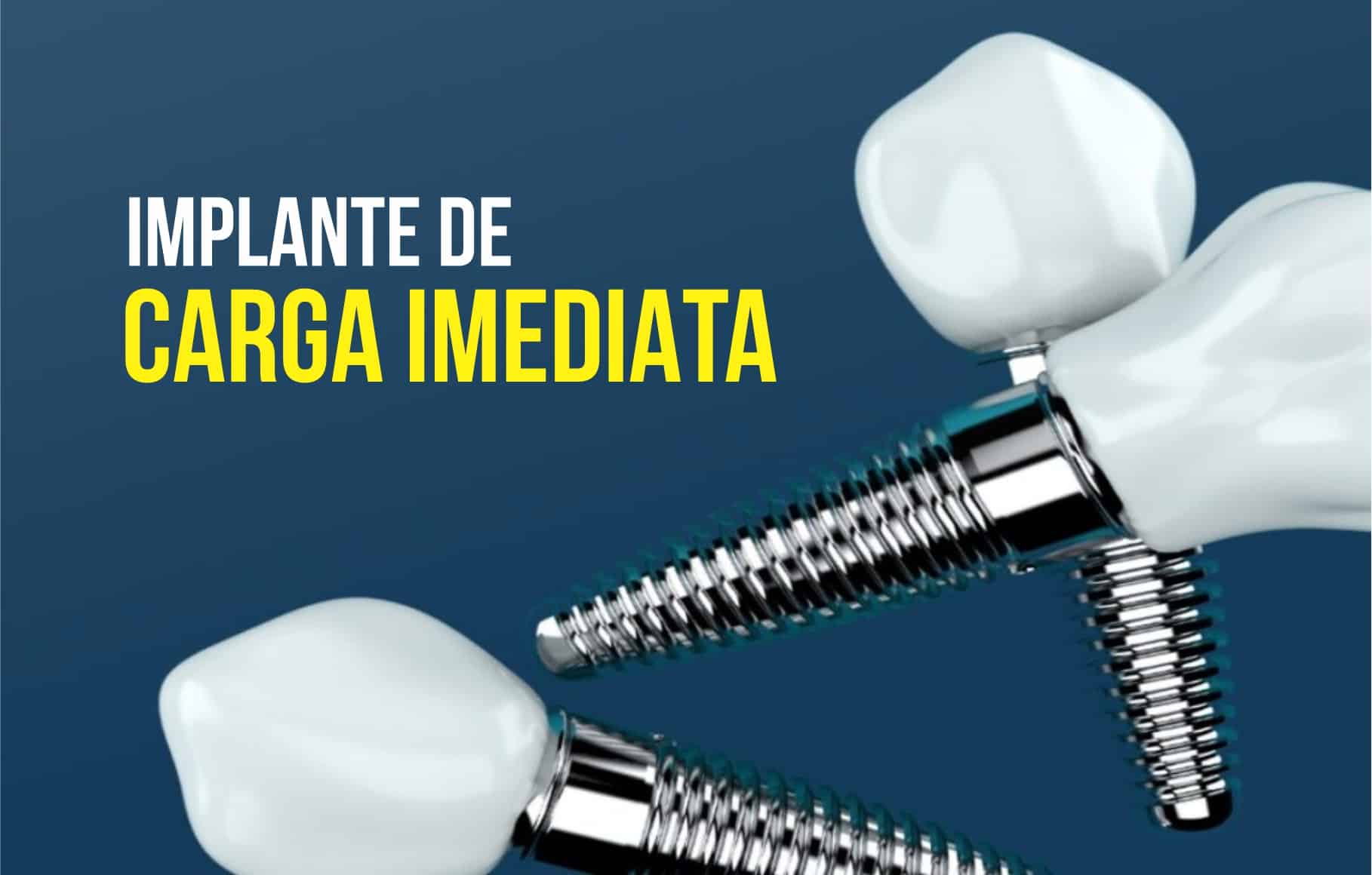 Implante de carga imediata: tudo o que você precisa saber!