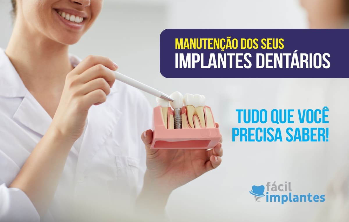 Manutenção de implantes dentários: o que você precisa saber!