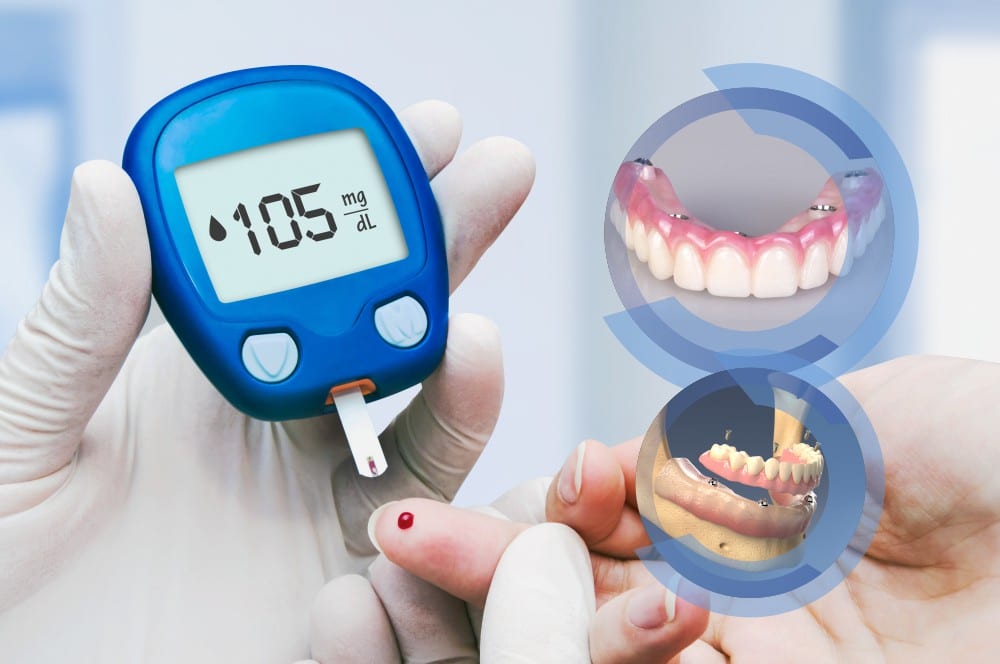 Implante dentário em diabéticos é possível? Saiba tudo sobre isso!