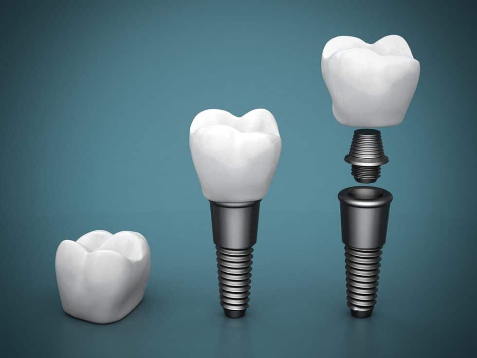 Como é Feito O Implante Dentário Passo A Passo Fácil Implantes 8292