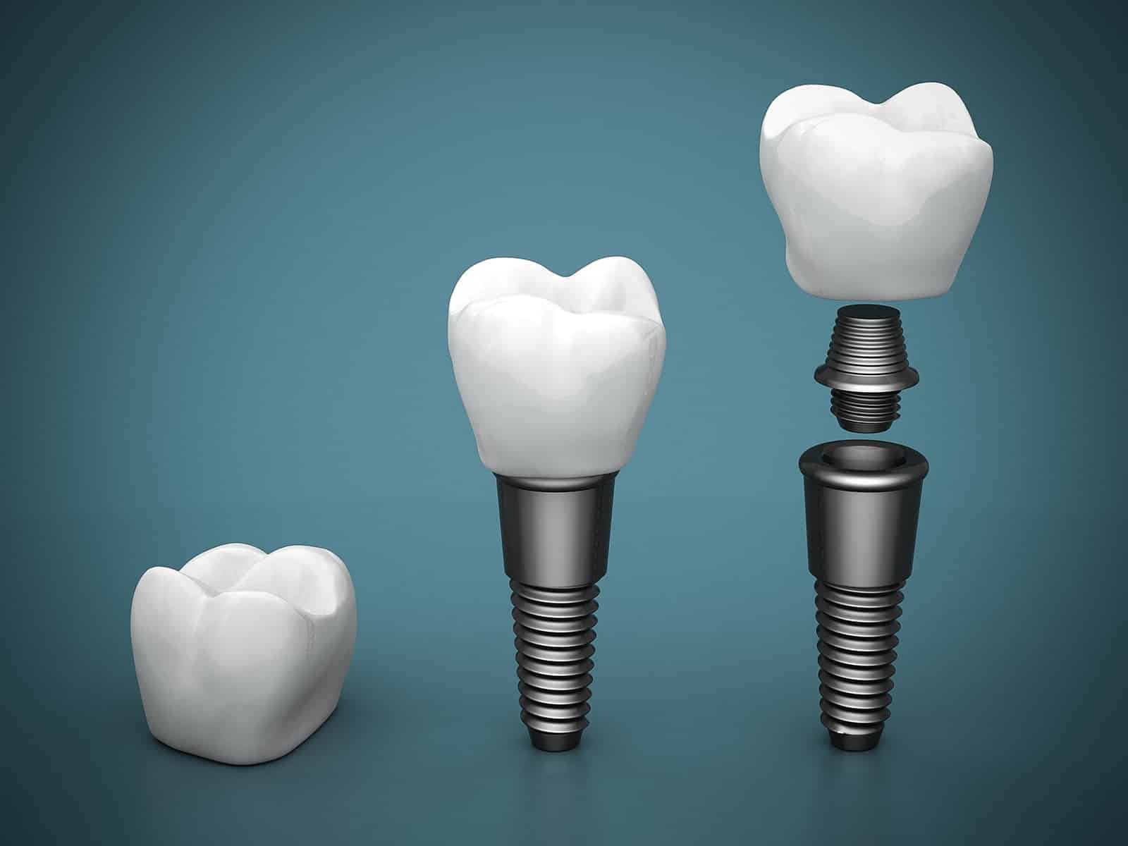 Como é feito o implante dentário: passo a passo
