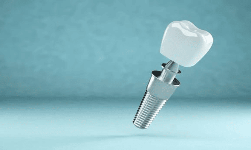 Extrair um dente e colocar um implante dentário no mesmo dia é possível?