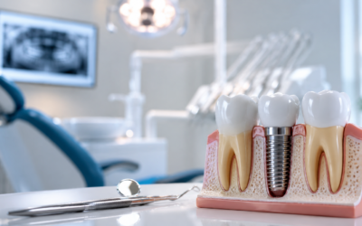 O Que É Implante Dentário? Guia Completo para Entender o Procedimento