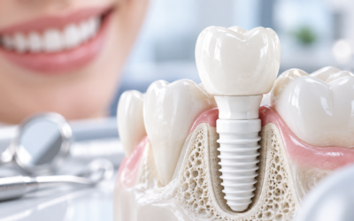 Implante dentário de zircônia: 7 pontos para saber se vale a pena